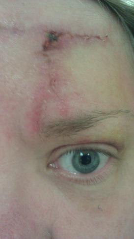 stitches out2.JPG